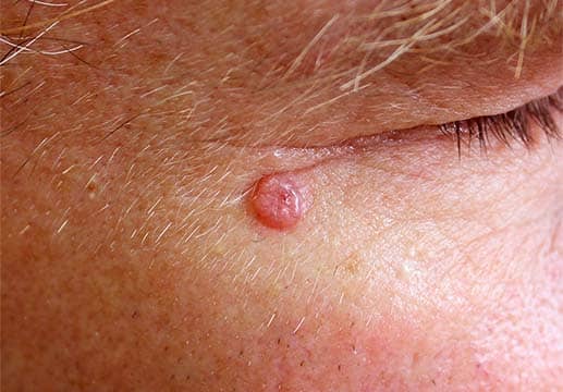 Cancer de la peau : causes | Centre de chirurgie Dermatologique Paris