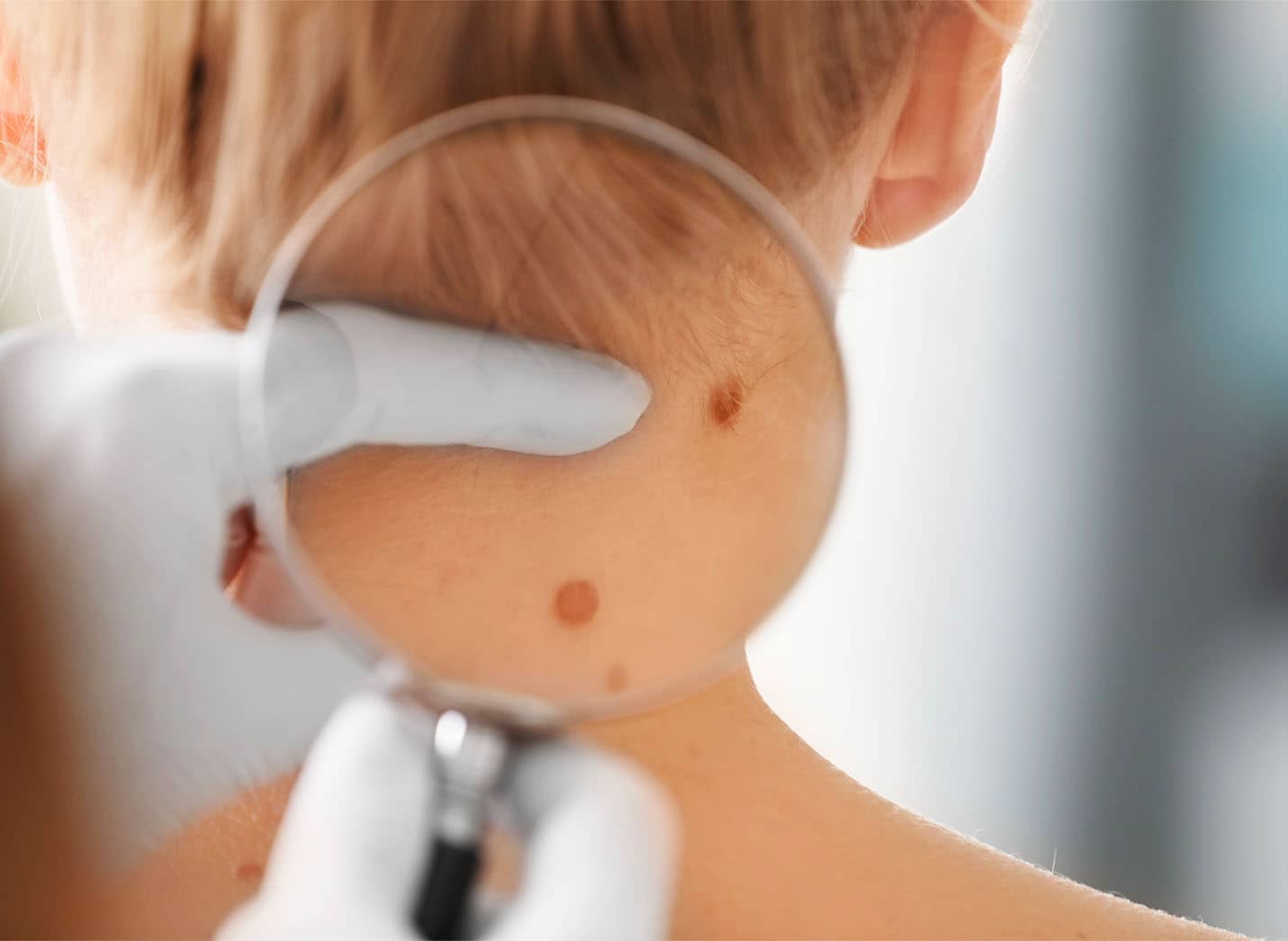 Chirurgie des grains de beauté : actes | Centre de chirurgie Dermatologique Paris 16