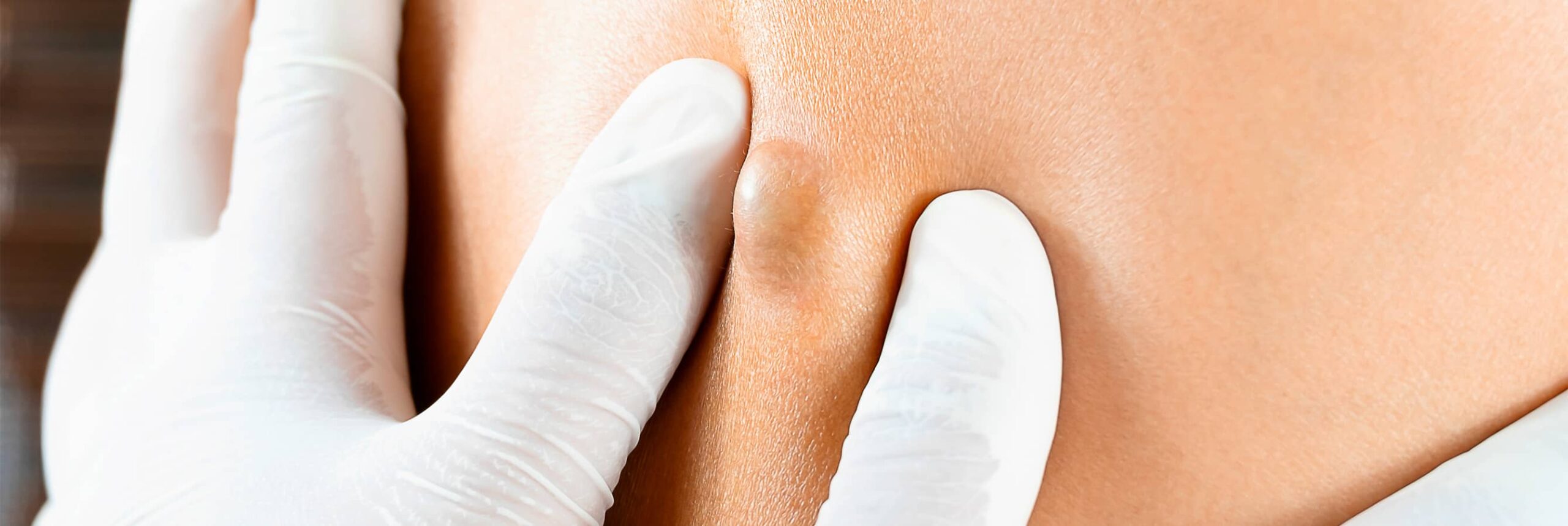 Kyste, abcès : différence | Paris | Centre de chirurgie Dermatologique