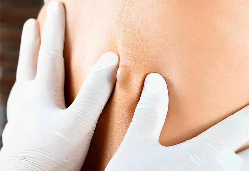 Kyste, abcès : différence | Centre de chirurgie Dermatologique | Actualité | Paris 16