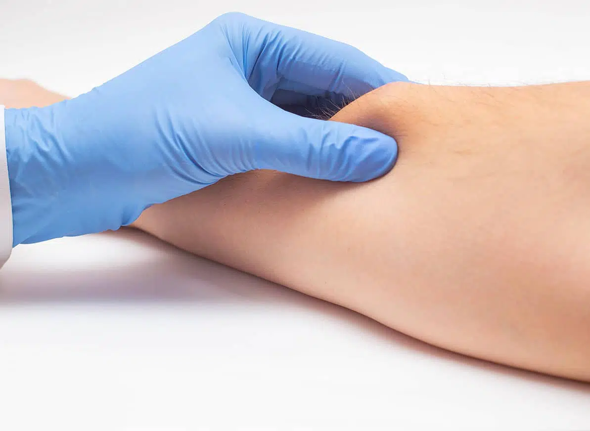 Chirurgie du lipome : actes et solutions | Centre de chirurgie Dermatologique Paris 16