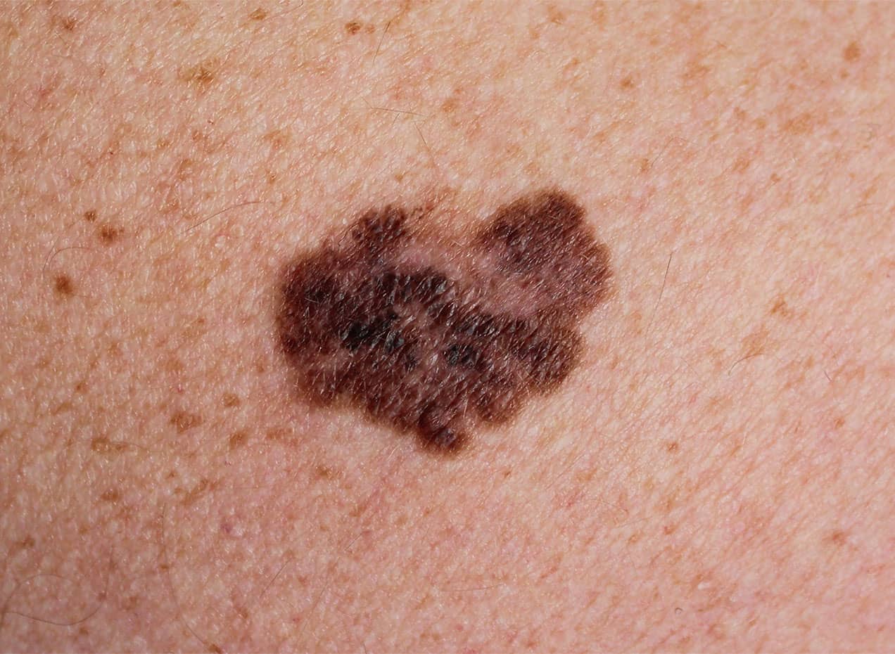 Traitement M lanome Centre Chirurgie Dermatologique Paris SurgiSkin