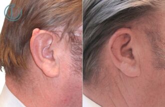 image cancer de l'oreille avant apres | Centre de chirurgie Dermatologique Paris 16
