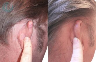 chirurgie carcinome oreille photo avant apres | Centre de chirurgie Dermatologique Paris 16