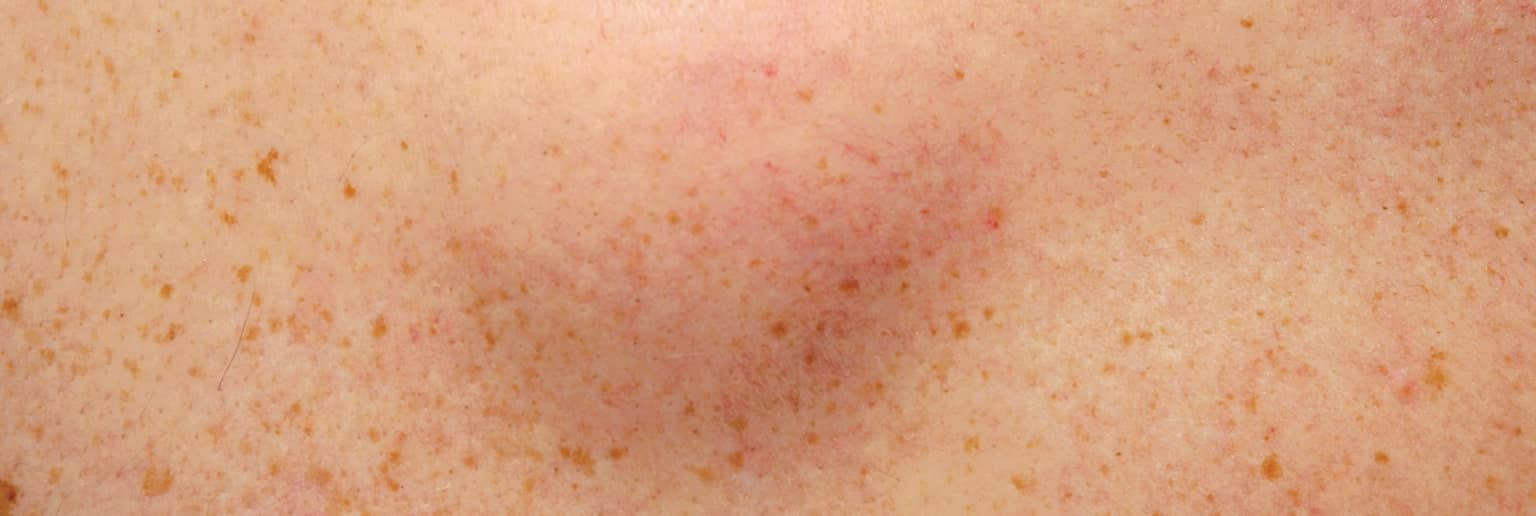 Est-ce qu’un lipome est un cancer ? | Centre chirurgie dermatologique | Paris