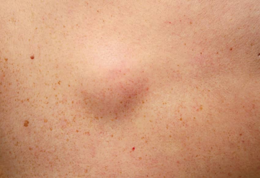Est Ce Qu Un Lipome Est Un Cancer Centre Chirurgie Dermatologique Paris