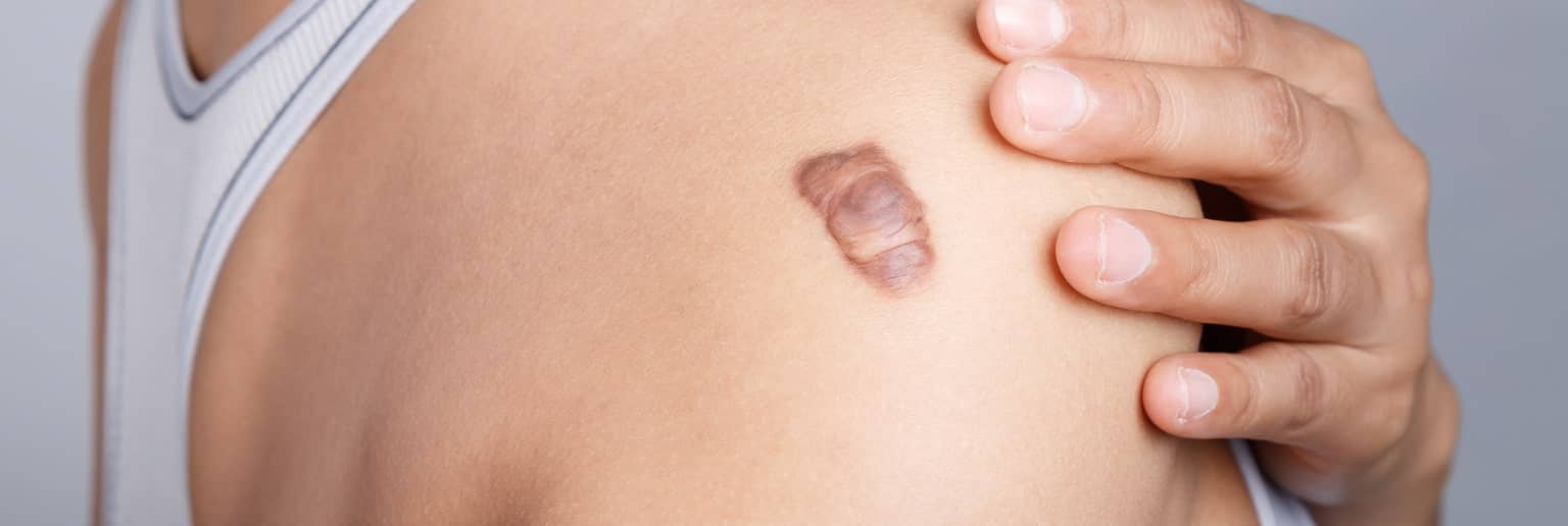 Comment savoir si on a une chéloïde ? | Centre chirurgie dermatologique | Paris