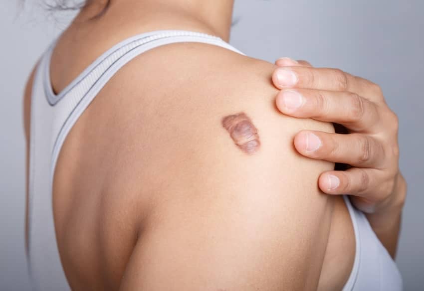 Comment savoir si on a une chéloïde ? | Centre chirurgie dermatologique | Paris