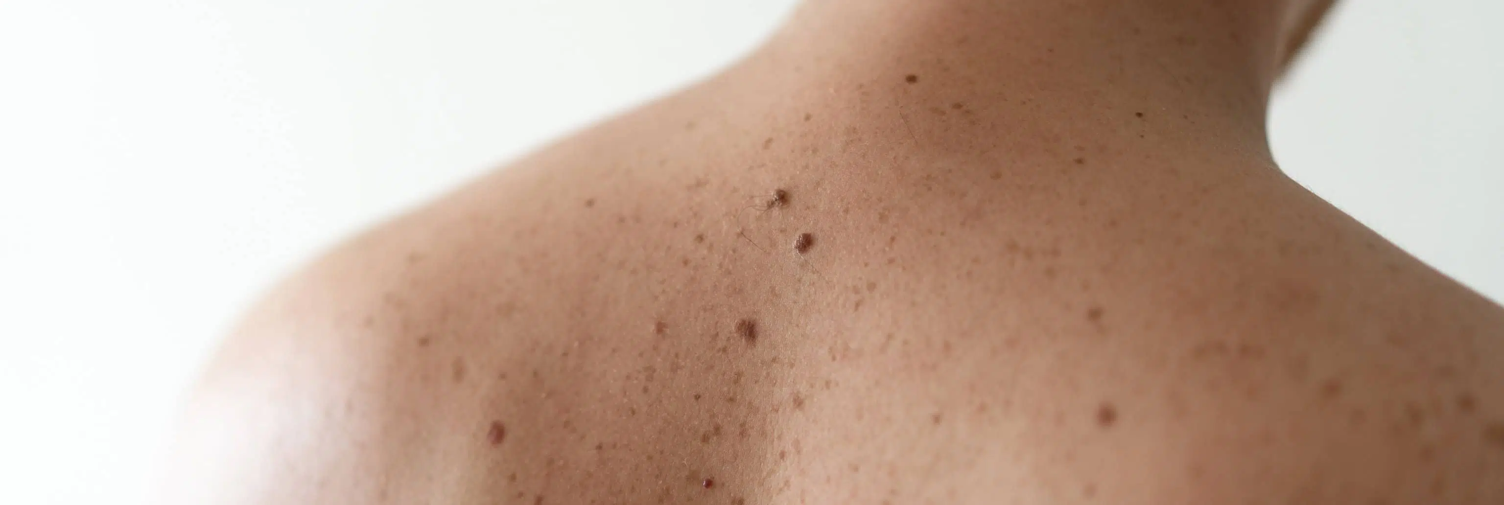 Différence entre carcinome et mélanome | Centre chirurgie dermatologique | Paris