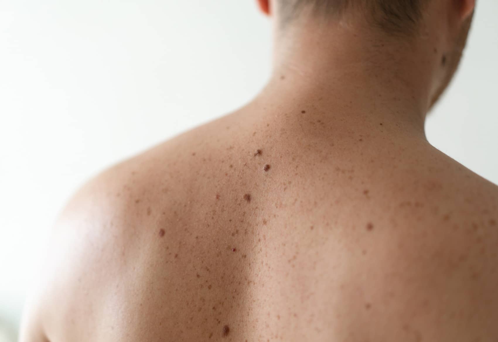 Différence entre carcinome et mélanome | Centre chirurgie dermatologique | Paris