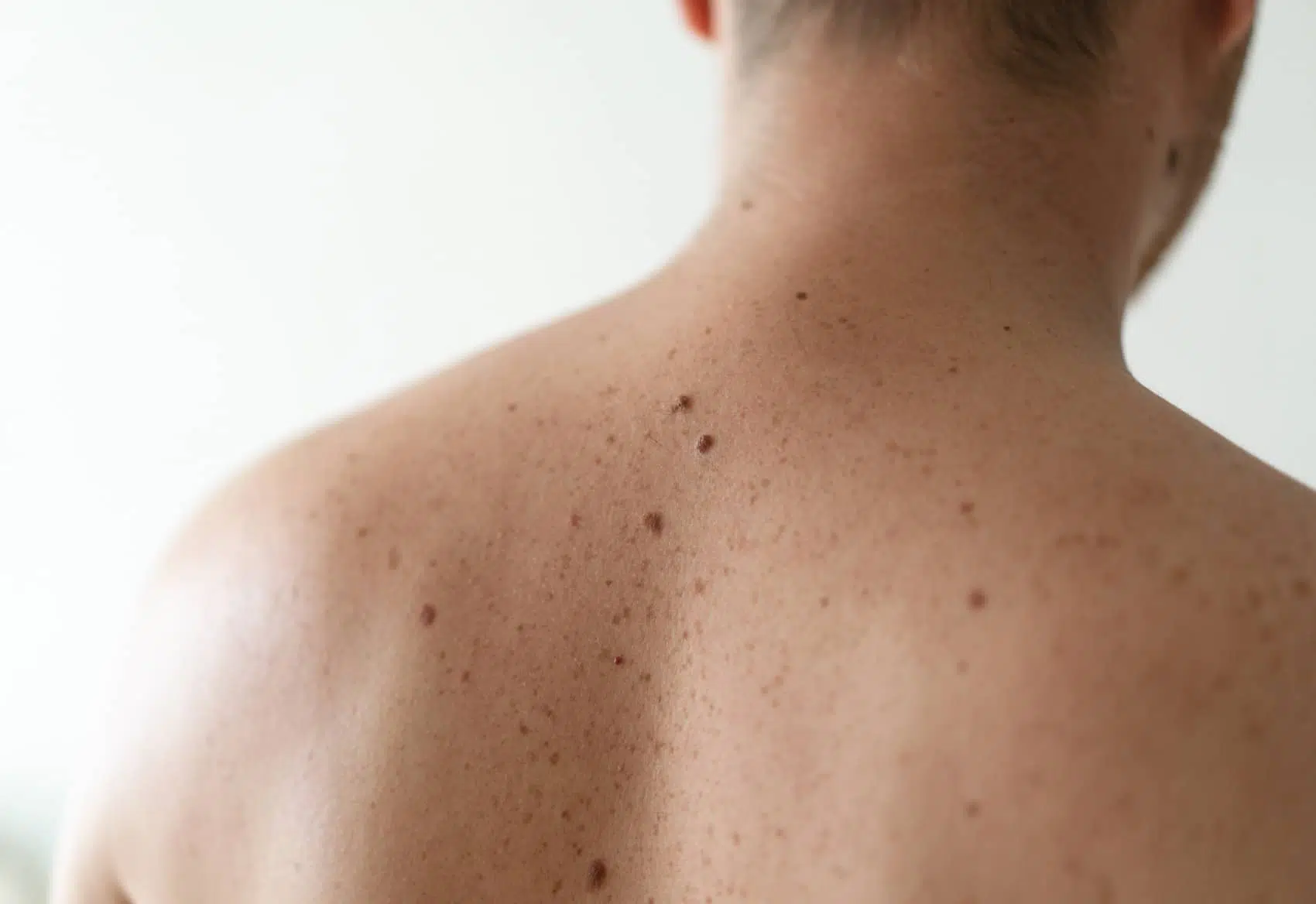 Différence entre carcinome et mélanome | Centre chirurgie dermatologique | Paris