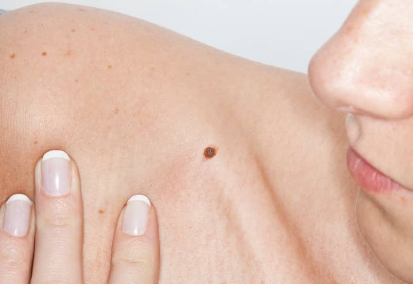 Grain de beauté qui saigne, que faire ? | Centre chirurgie dermatologique | Paris