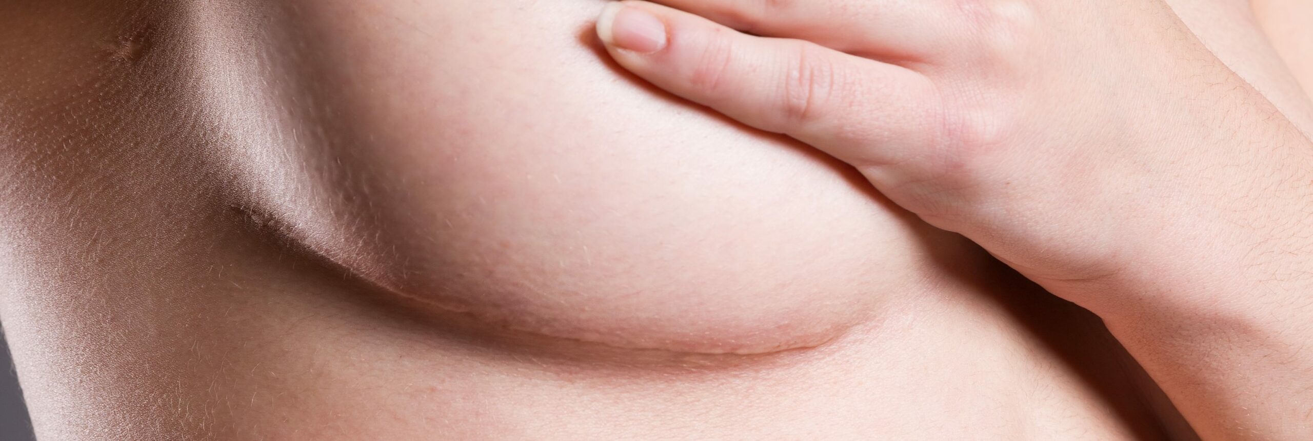 Traitement des cicatrices des seins | Centre chirurgie dermatologique | Paris