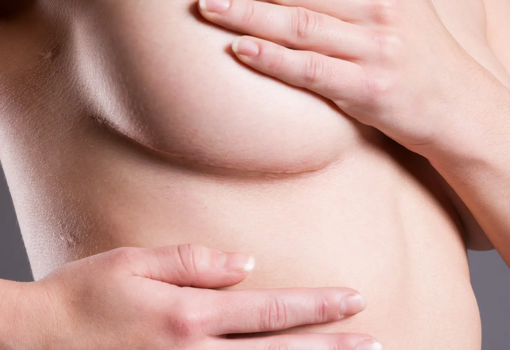Traitement des cicatrices des seins | Centre chirurgie dermatologique | Paris