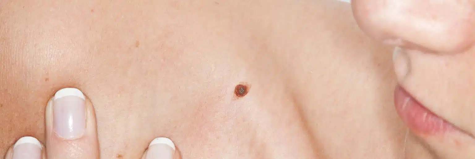 Comment reconnaître un mélanome ? | Centre chirurgie dermatologique | Paris