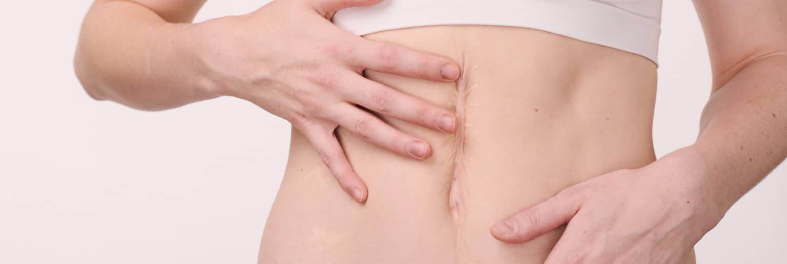 Dans quels cas la reprise de cicatrices est-elle prise en charge par la sécurité sociale ? | Centre chirurgie dermatologique | Paris