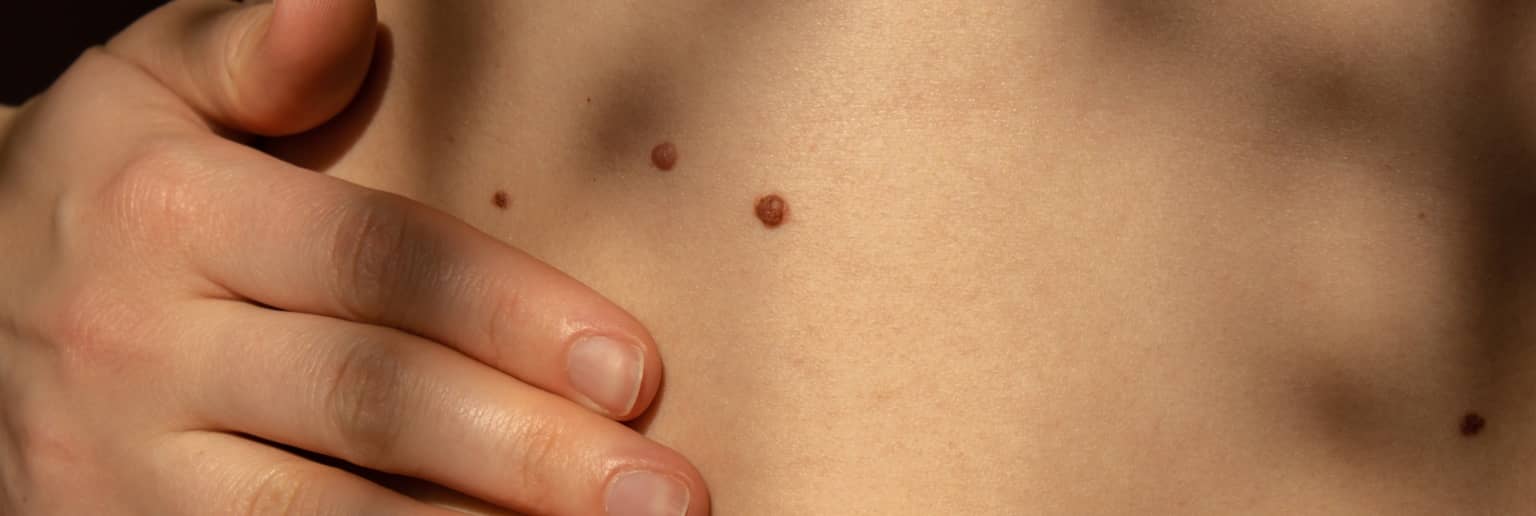 Quels sont les facteurs d'apparition des carcinomes basocellulaires ? | Centre chirurgie dermatologique | Paris