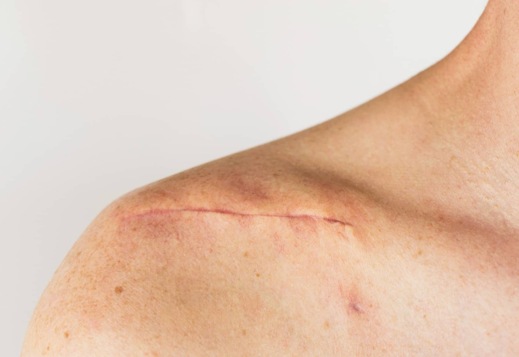 Dans quels cas peut-on envisager une reprise de cicatrices ? | Centre chirurgie dermatologique | Paris