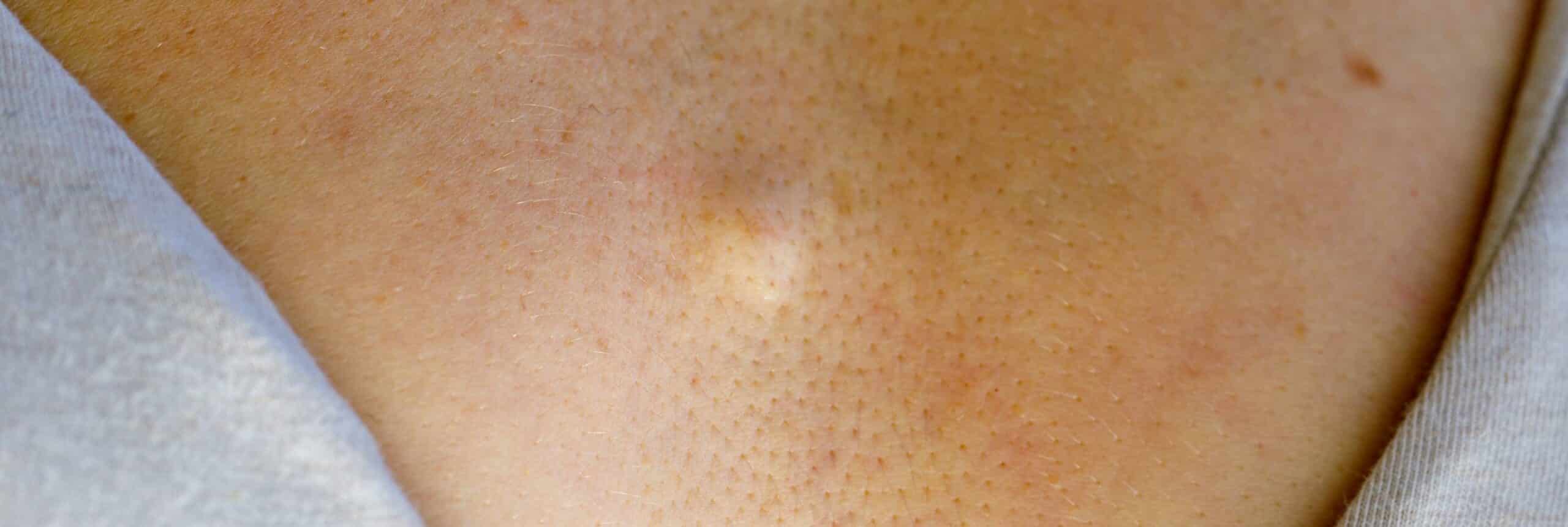 Que faire si j'ai un lipome qui me fait mal ? | Centre chirurgie dermatologique | Paris