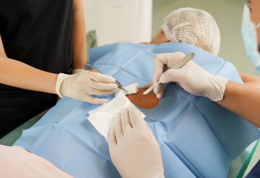 La chirurgie est-elle obligatoire pour retirer un carcinome basocellulaire ? | Centre chirurgie dermatologique | Paris