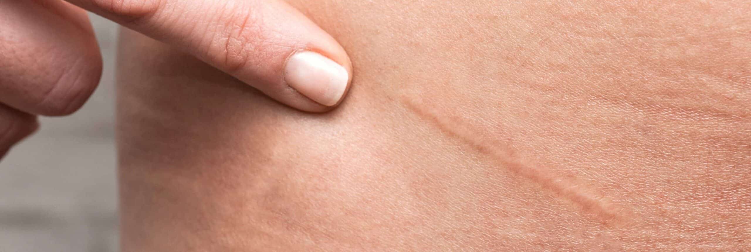 Comment évolue une cicatrice chirurgicale ? | Centre chirurgie dermatologique | Paris