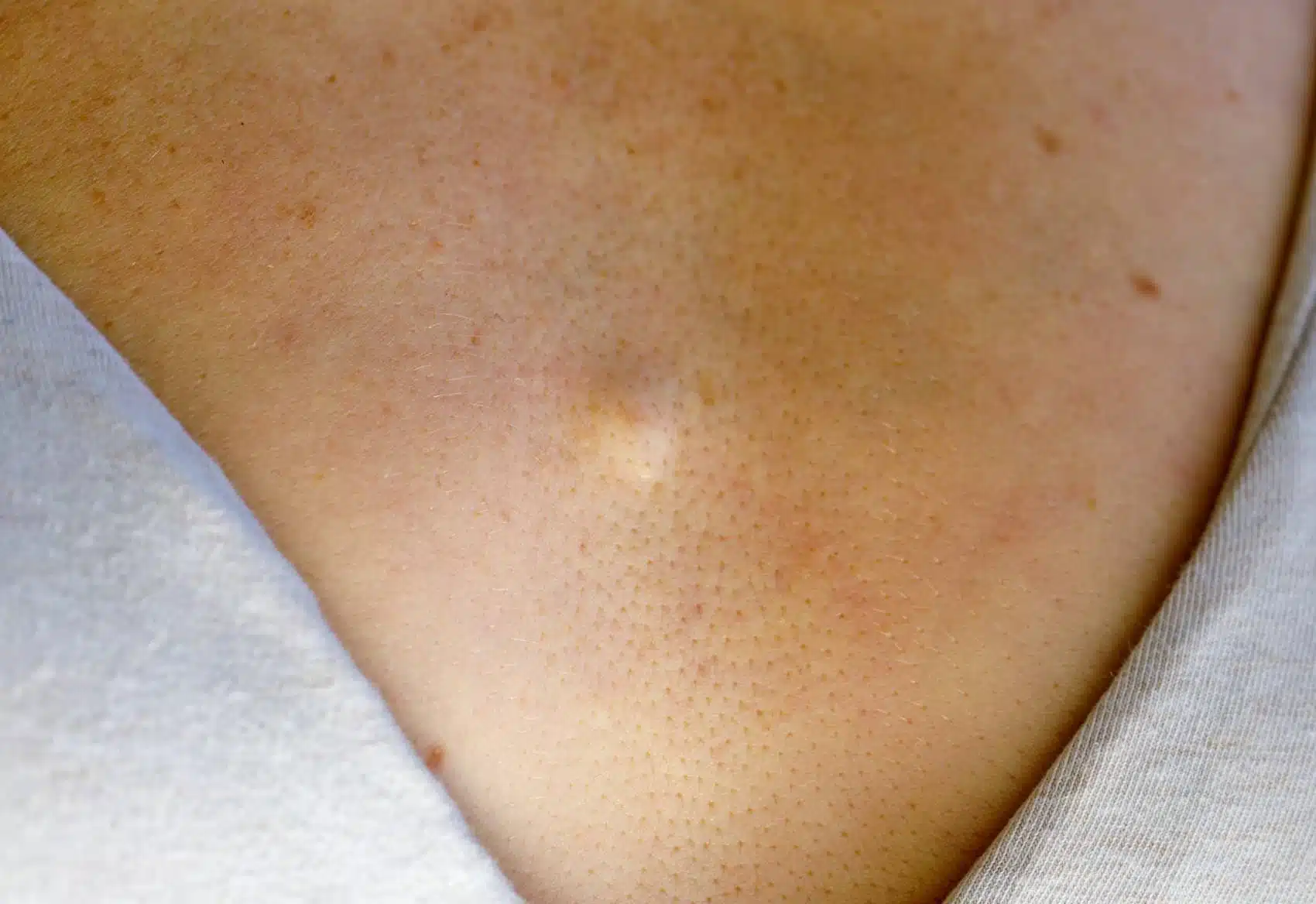 Quand faut-il envisager une anesthésie générale pour faire retirer un lipome ? | Centre chirurgie dermatologique | Paris