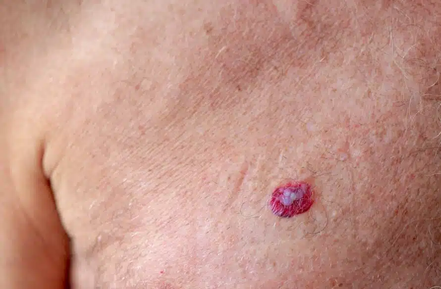 Comment reconnaître un carcinome basocellulaire ? | Centre chirurgie dermatologique | Paris