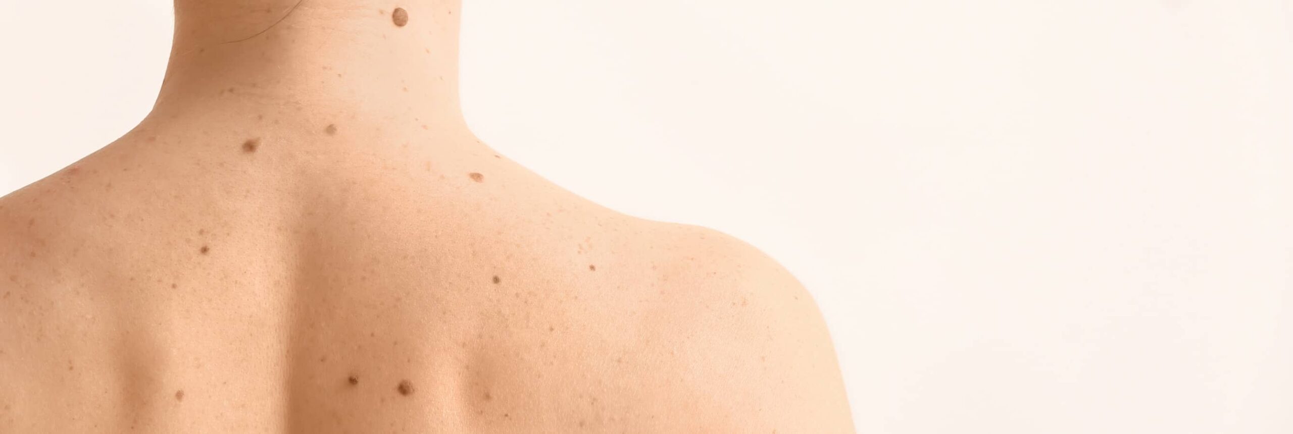 Quels sont les différents types de mélanomes | Centre chirurgie dermatologique | Paris