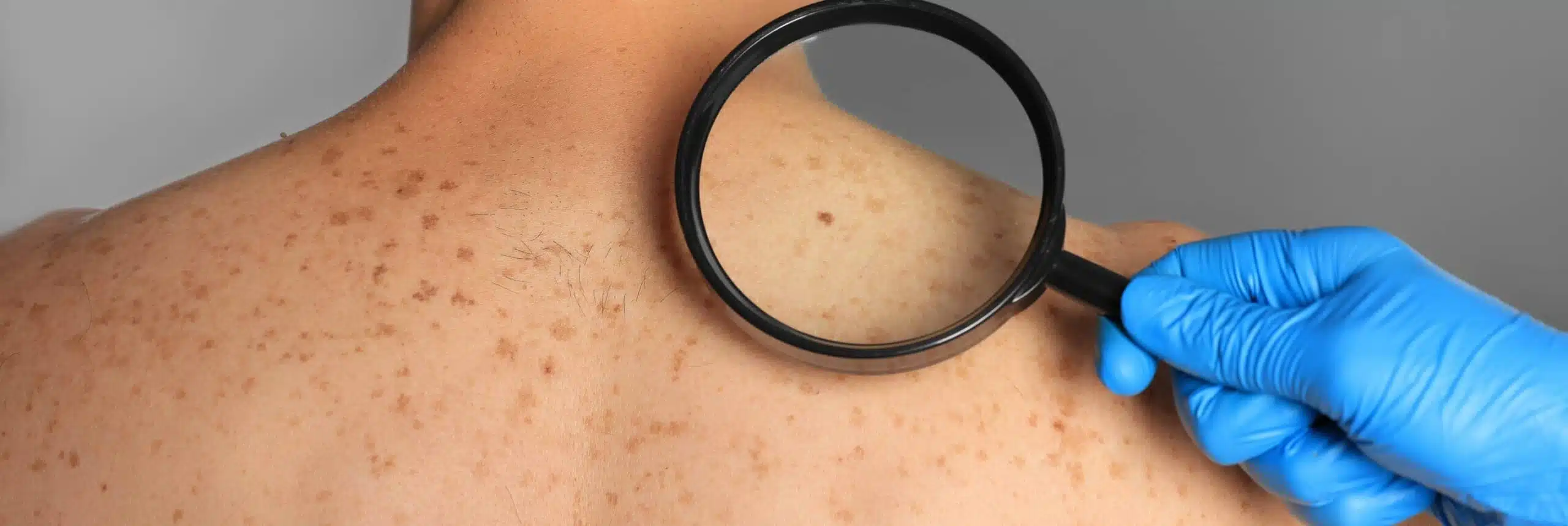 Prévention et détection précoce des cancers de la peau | Centre chirurgie dermatologique | Paris