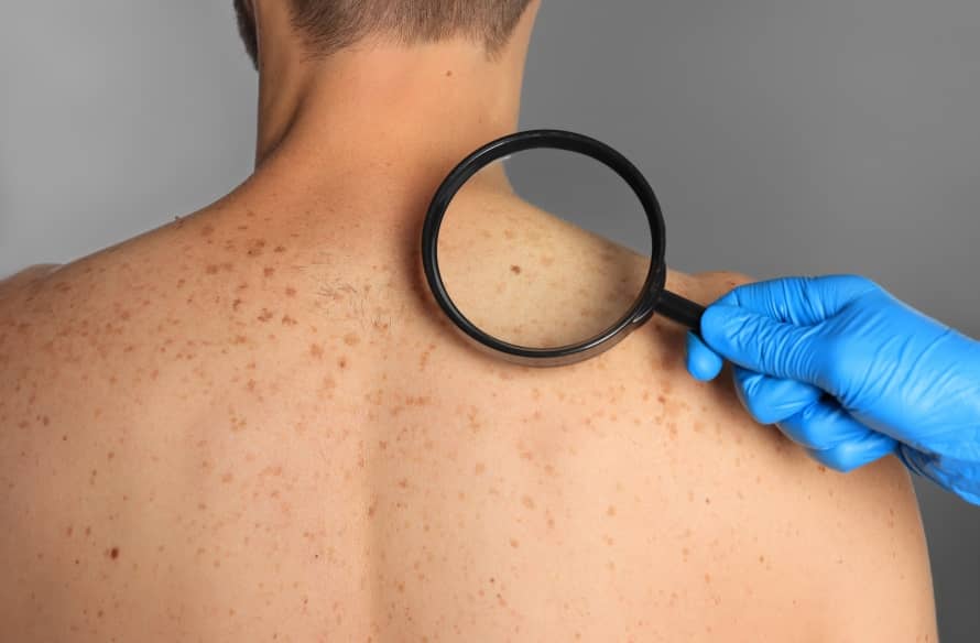 Prévention et détection précoce des cancers de la peau | Centre chirurgie dermatologique | Paris