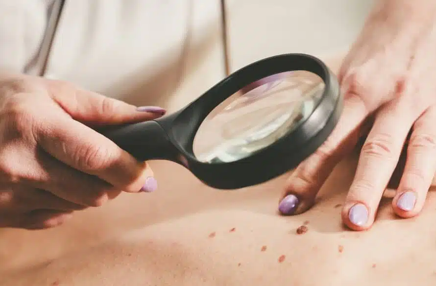 Qu’est-ce qu’un carcinome épidermoïde ? | Centre chirurgie dermatologique | Paris