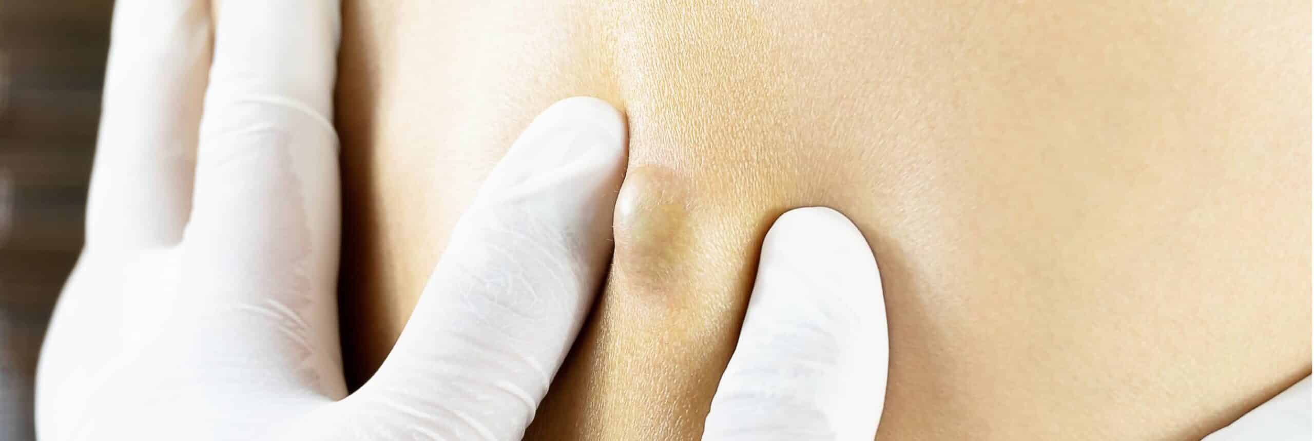 Kyste douloureux : que faire ? | Centre chirurgie dermatologique | Paris