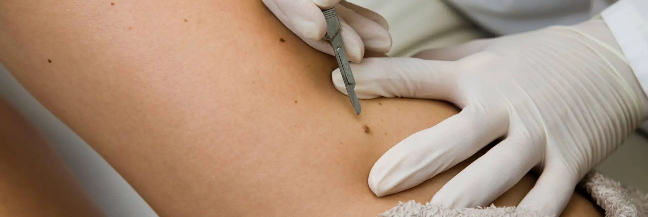 Comment prévenir la récidive du carcinome basocellulaire | Centre chirurgie dermatologique | Paris