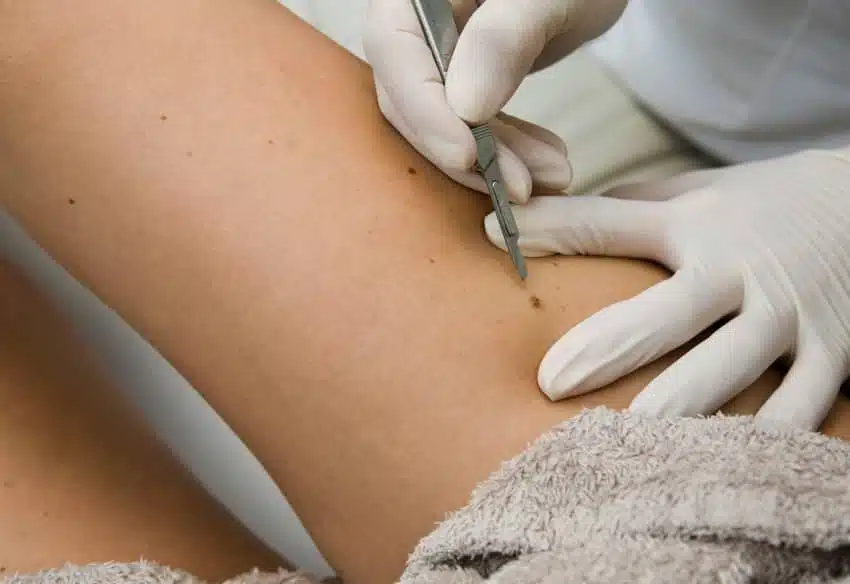 Comment prévenir la récidive du carcinome basocellulaire | Centre chirurgie dermatologique | Paris