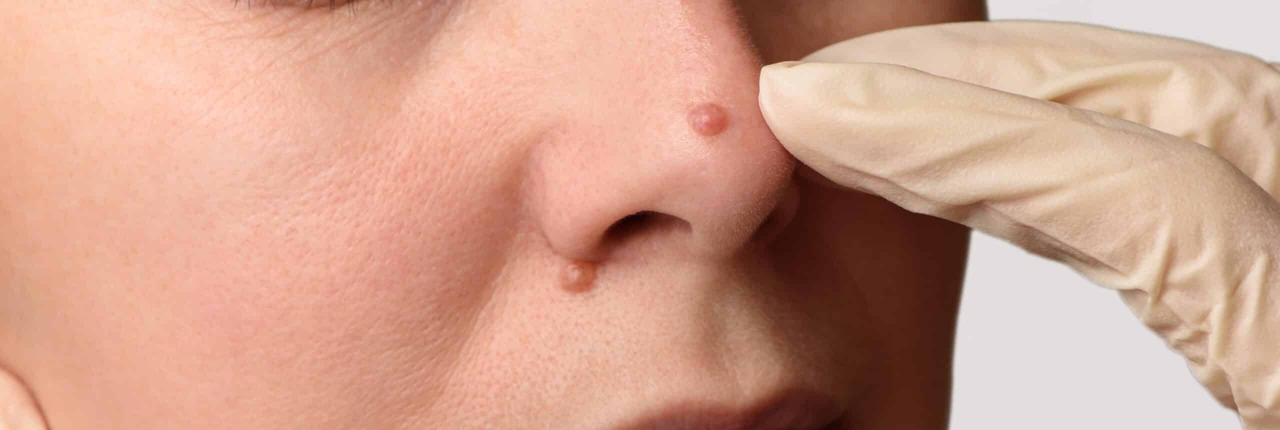 Comment retirer un carcinome sur le nez ?| Centre chirurgie dermatologique | Paris