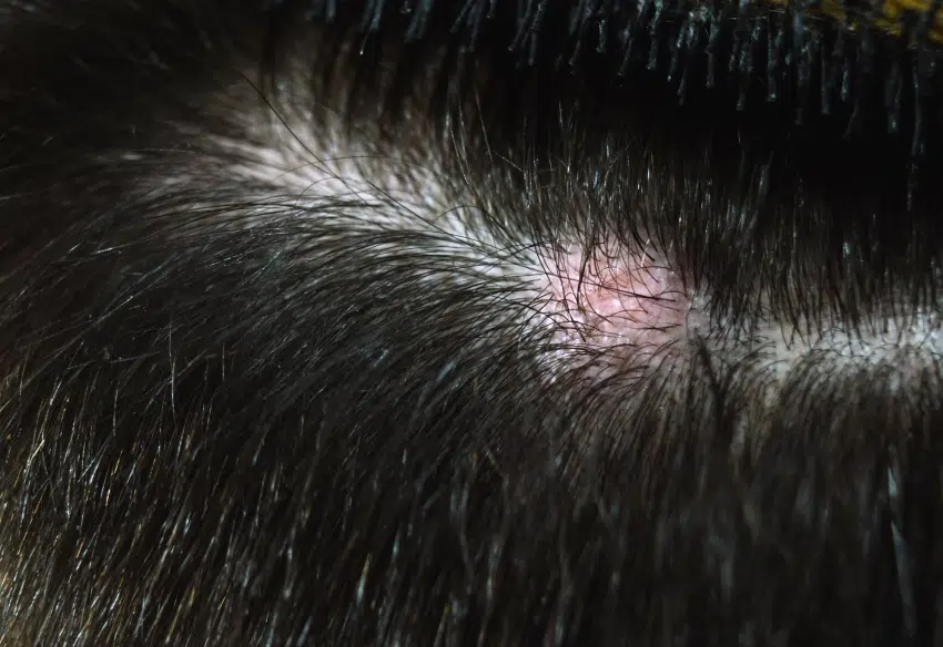 Le rasage est-il obligatoire avant le retrait d’un kyste ? | Centre chirurgie dermatologique | Paris