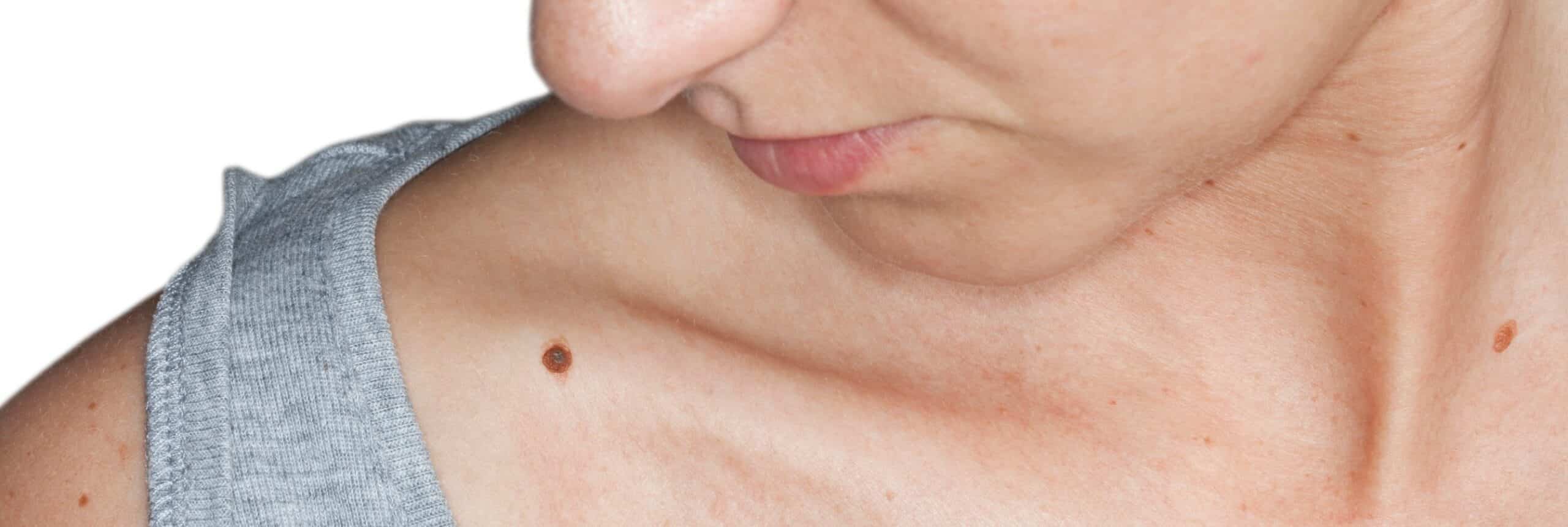Nouveaux grains de beauté : que faire ? | Centre chirurgie dermatologique | Paris
