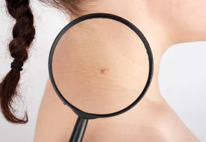 Diagnostic et traitement des carcinomes basocellulaires | Centre chirurgie dermatologique | Paris