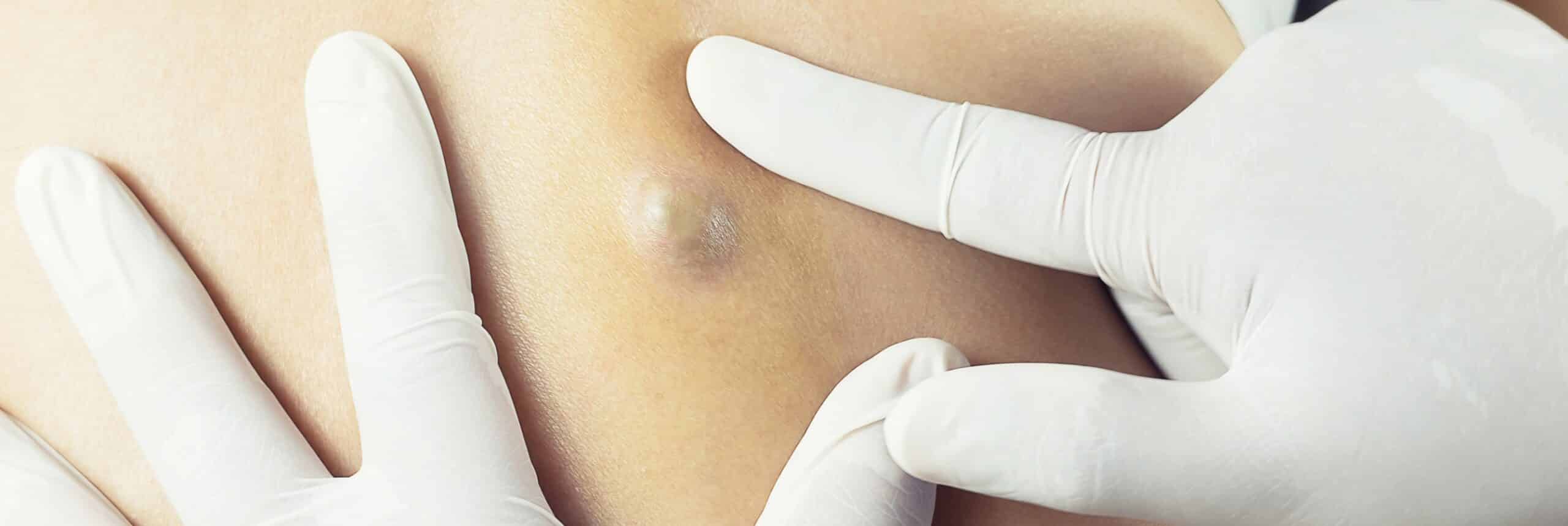 Causes kystes cutanés | Centre chirurgie dermatologique | Paris