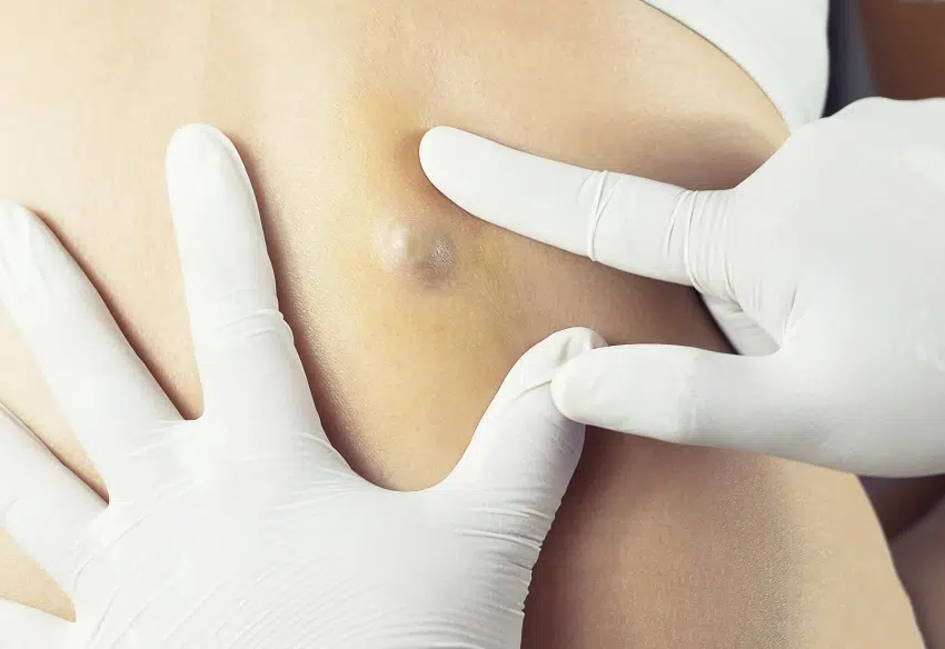 Causes kystes cutanés | Centre chirurgie dermatologique | Paris