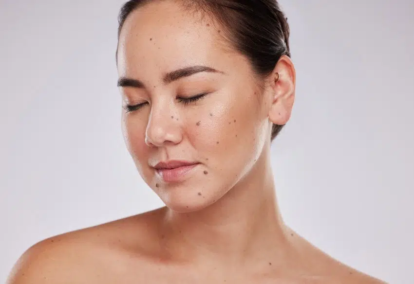 Retirer grain de beauté inesthétique| Centre chirurgie dermatologique | Paris