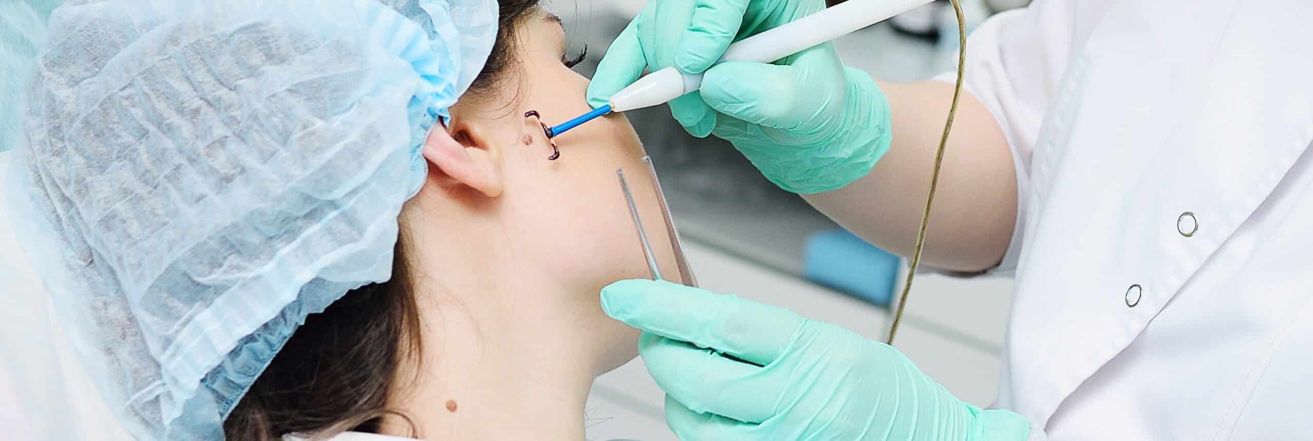 Ablation de kystes