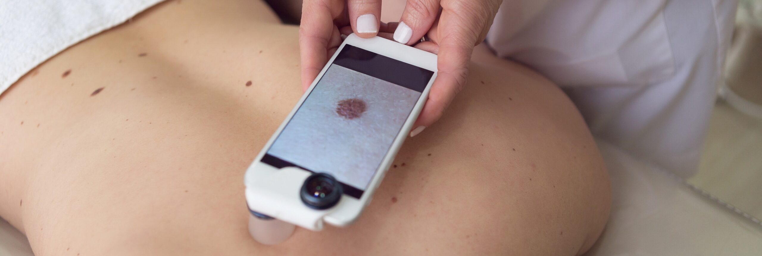 Traitement des melanomes