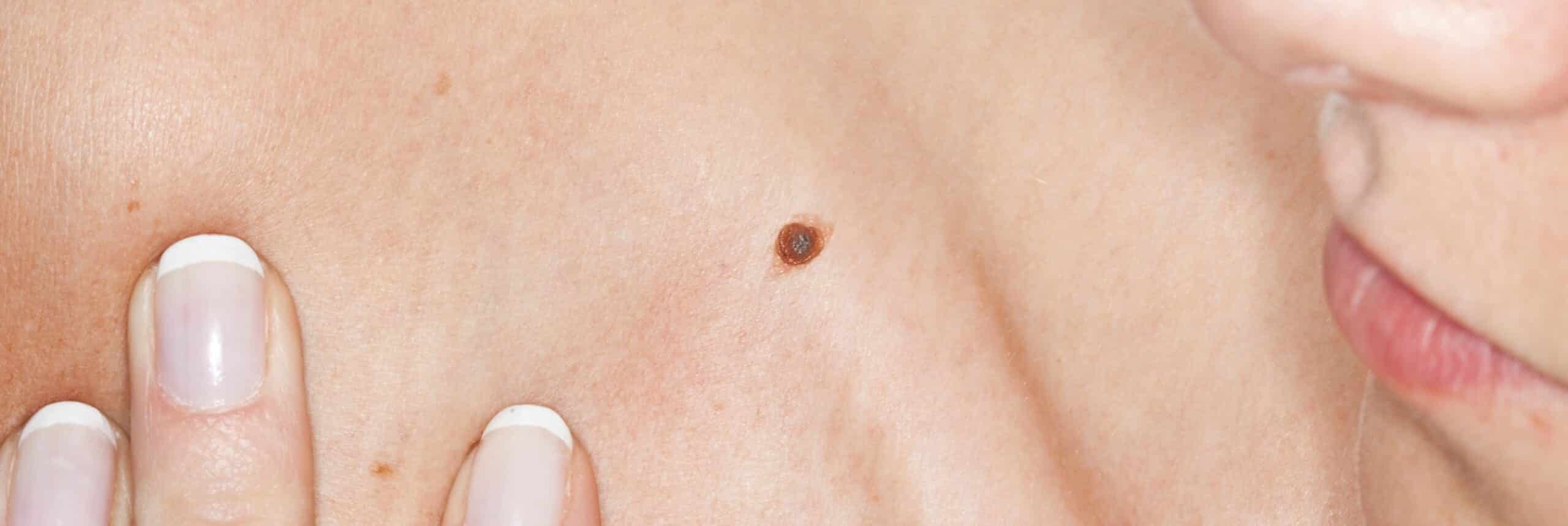Retrait grain de beauté