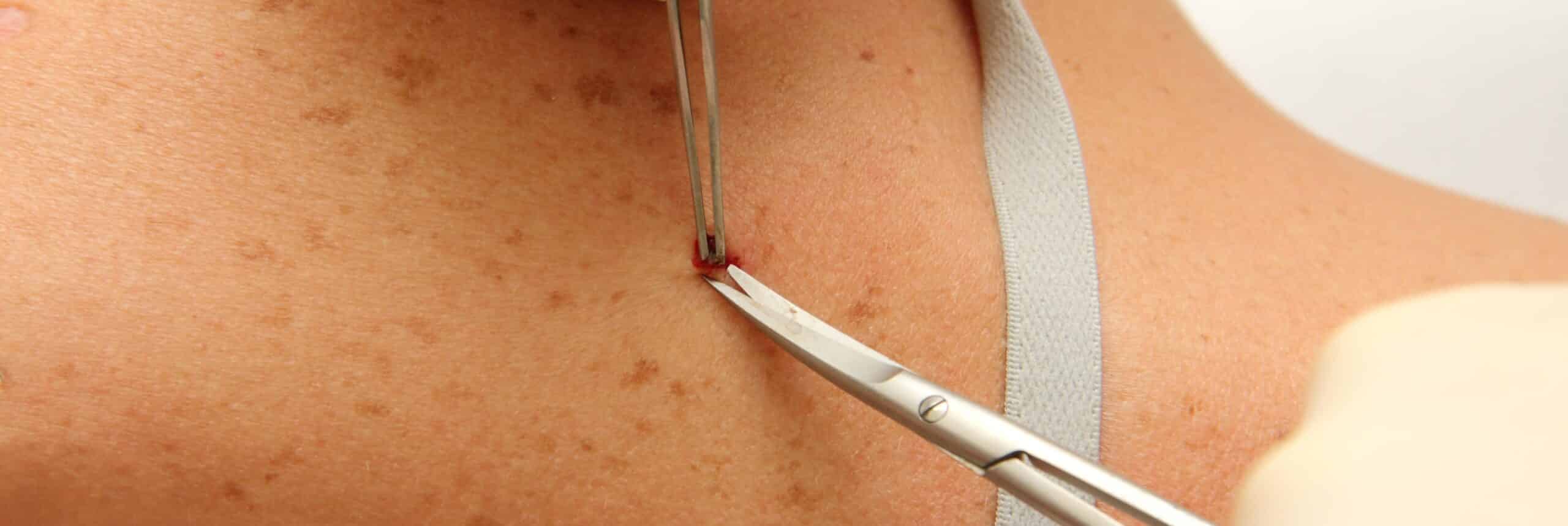 Chirurgie dermatologique