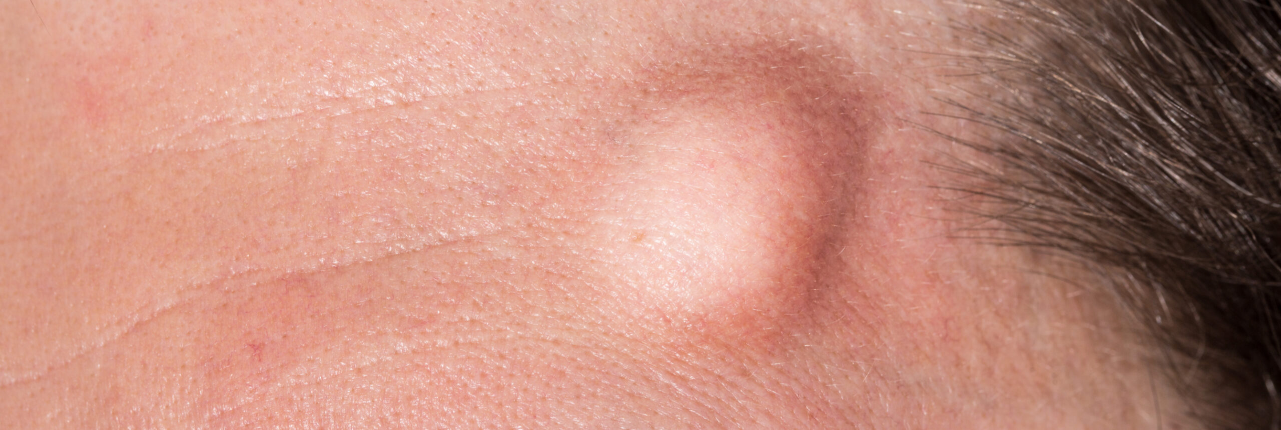 Quand Faut il Retirer Un Kyste Centre Chirurgie Dermatologique Paris Quand Faut il Retirer Un Kyste Centre Chirurgie Dermatologique Paris
