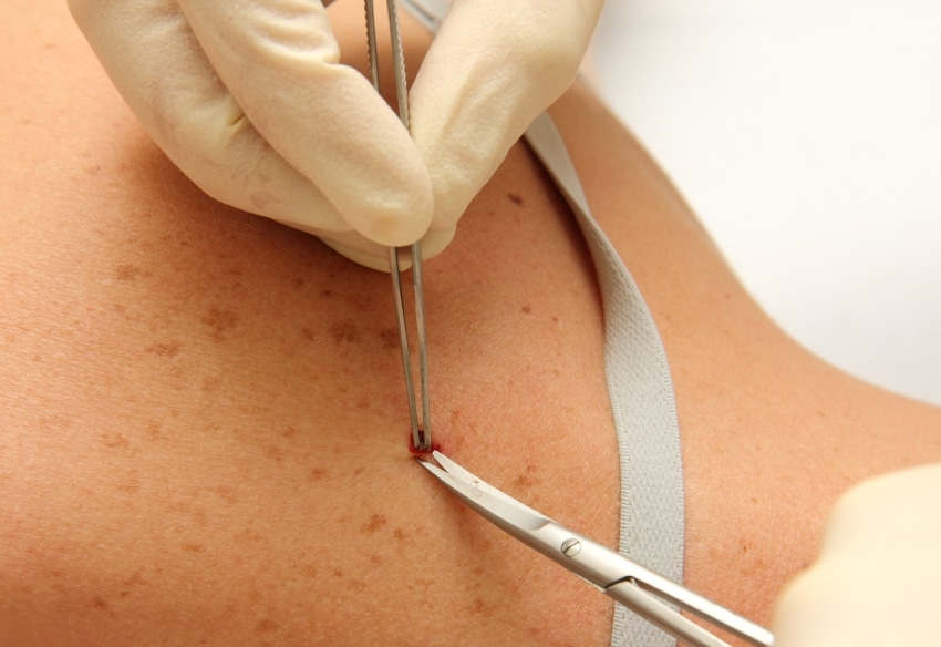 Chirurgie dermatologique