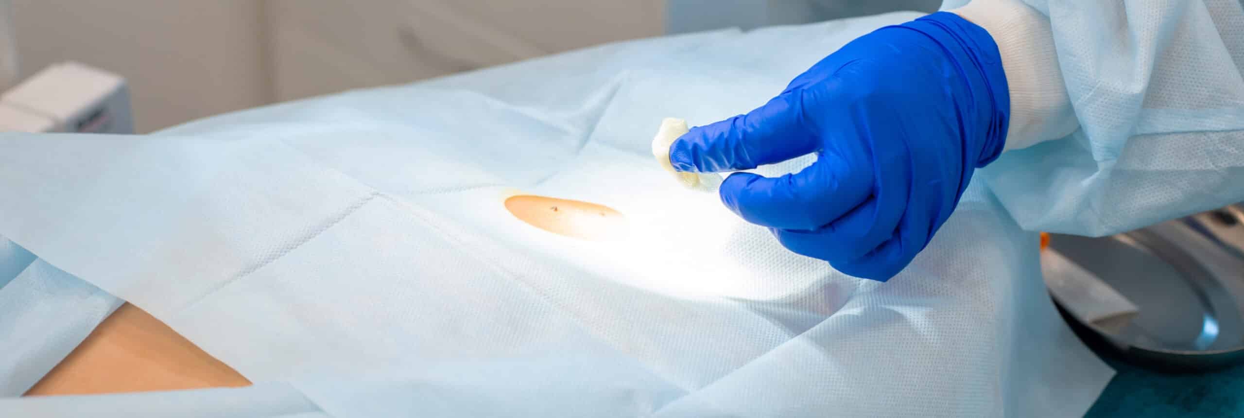 Chirurgie grain de beauté