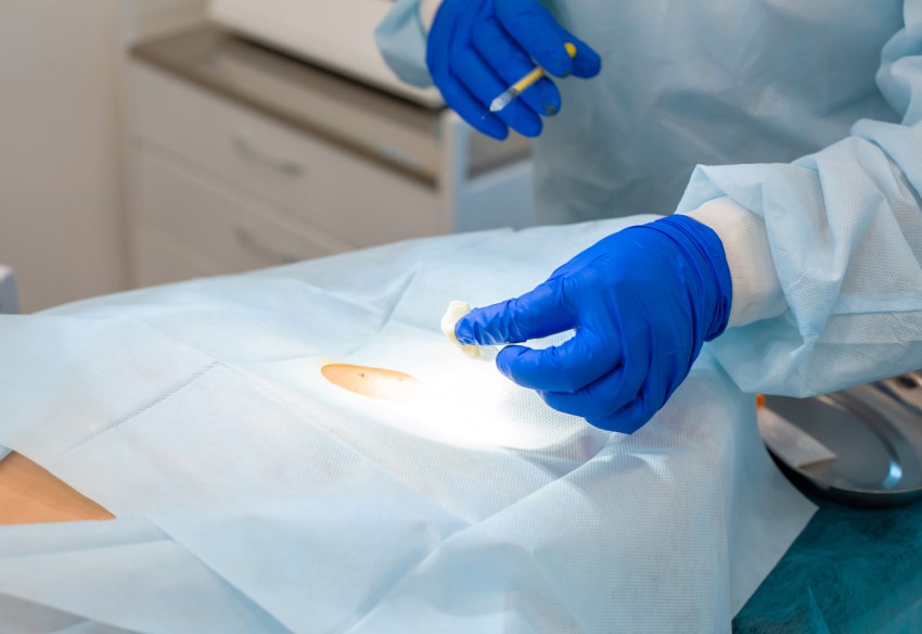 Chirurgie grain de beauté