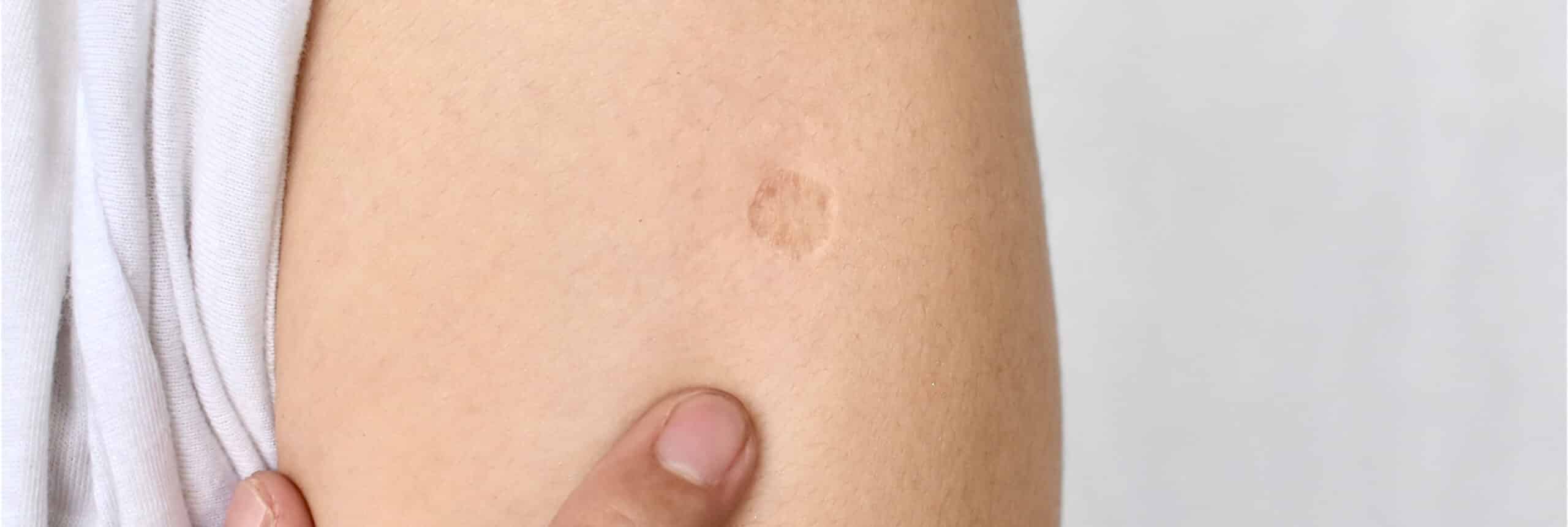 cicatrices grain de beauté